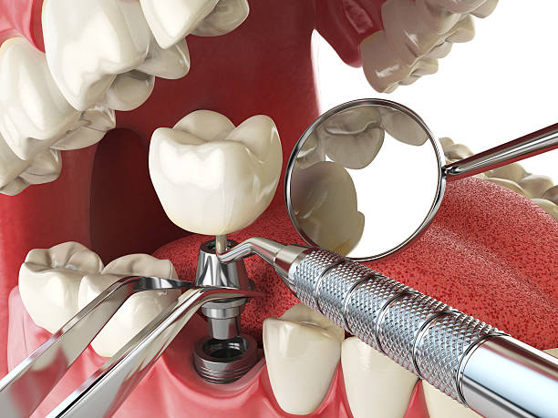 Best Emergency Denture Repair in Tustin, CA